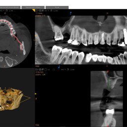 CBCT (TAC)